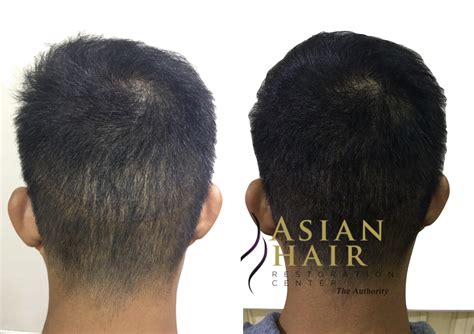 Scalp Micropigmentation Philippines .